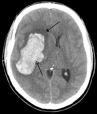 brain scan with abnormal lump