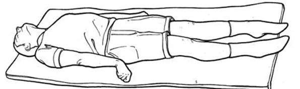 diagram of Decerebrate Rigidity after a stroke