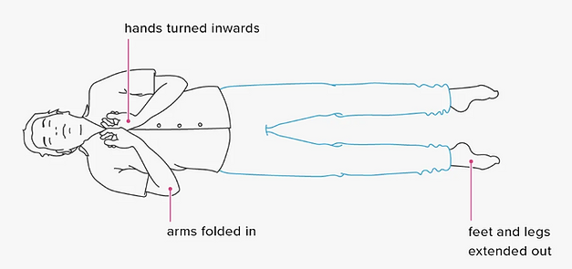 diagram of Decorticate Rigidity after a stroke