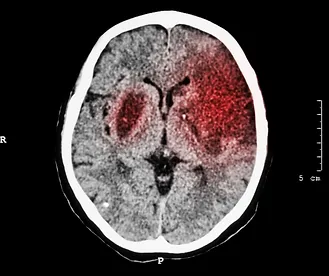 Ischemic Stroke: