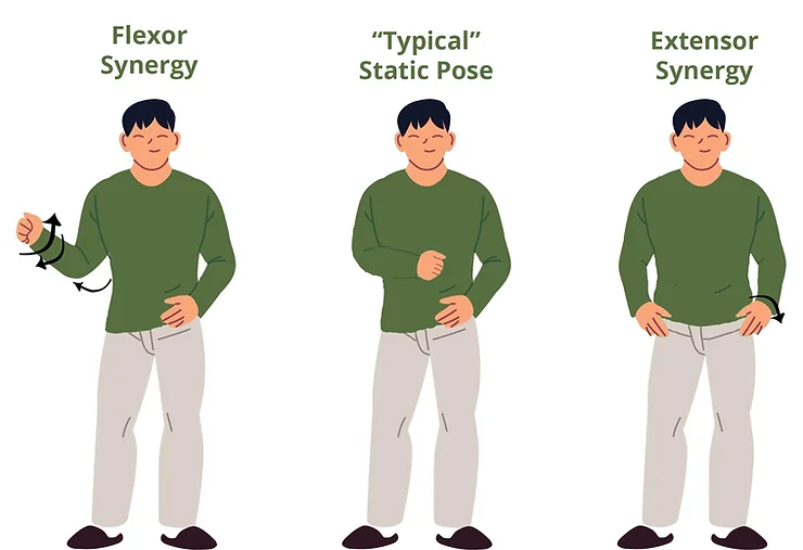 Flexor Synergy vs Static Pose vs Extensor Synergy